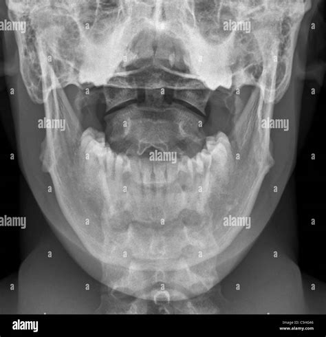 Normal neck x ray hi-res stock photography and images - Alamy