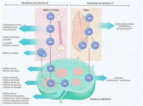 PatologíaBlog2014: Leucemia linfoblástica aguda