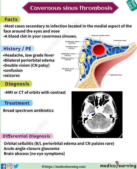 Cavernous sinus thrombosis flash card | Sinusitis, Medical knowledge, Medical school essentials