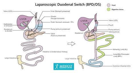 Duodenal Switch Surgery