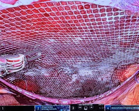 Mesh Reinforcement — Ballarat Hernia Clinic | Complex Hernia Repair | Dr Daniel Wong | Dr James Ross