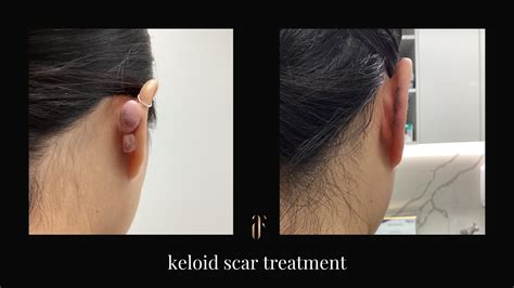 Keloid Ear Piercing