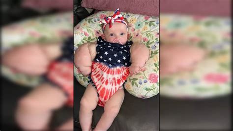 Baby Hulk: Born With Enormous Arms And Chest, Tot Suffers A Rare Health ...