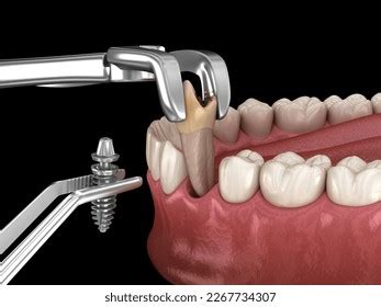 Image result for What Is a Complex Tooth Extraction