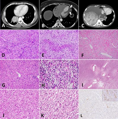 Spindle Cell Fibrohistiocytic Tumor at Jean Henry blog