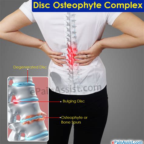 Disc Osteophyte Complex: Treatment, Symptoms, Causes