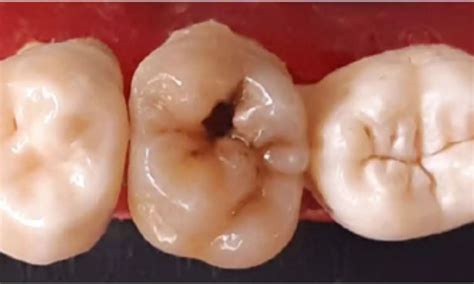 Fluoride Varnish and Glass Ionomer Cement Sealants Equally Effective ...