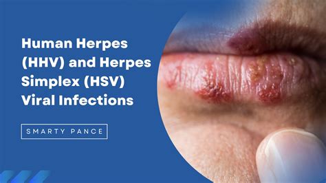 Herpes Virus Women