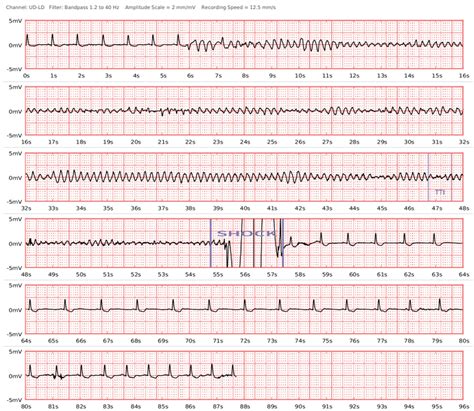 PO-05-154 SUCCESSFUL DEFIBRILLATION OF VENTRICULAR FIBRILLATION WITH A NOVEL PATCH WEARABLE ...
