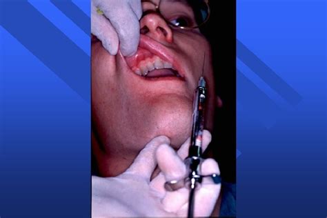 Infiltration Anesthesia 的图像结果