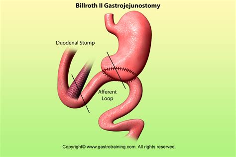 Billroth Surgery