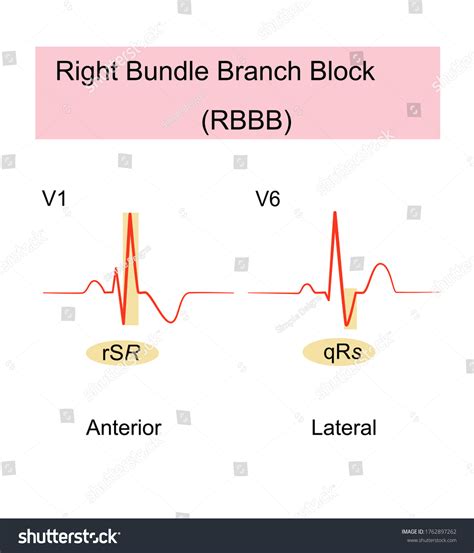 Finalas suspėti Jūs tapsite geresni sinus rhythm right bundle branch block Uždrausti kaimas ...