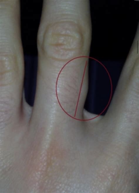 What can be this painless and hard lump on finger? : r/DermatologyQuestions