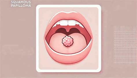 Squamous Papilloma: Causes, Symptoms, and Treatments