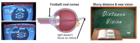 Myopia, Hyperopia, Presbyopia
