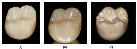 Comparison of Fracture Strengths of Three Provisional Prosthodontic CAD ...