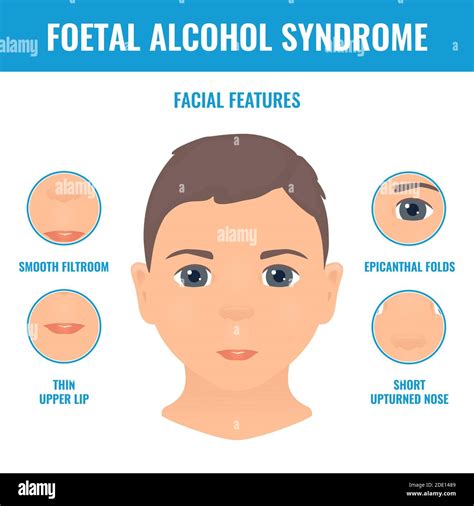 Fetal Alcohol Syndrome Adults Face