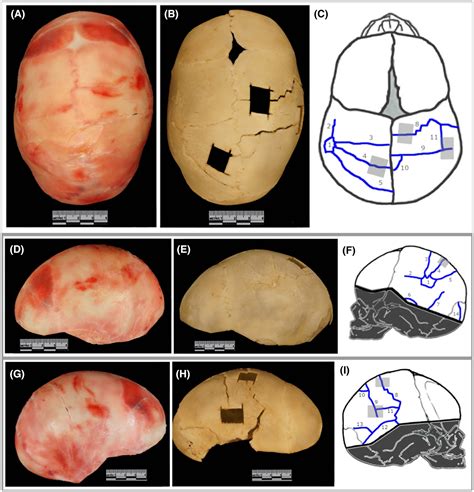 An unusual blunt force trauma pattern and mechanism to the cranial vault: Investigation of an ...