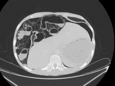 Pneumatosis cystoides intestinalis on computed tomography, an infrequent pathology | Eurorad