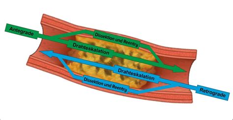 Der chronische Koronarverschluss - Kardiologie & Gefäßmedizin ...
