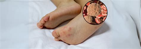 Invasive Meningococcal Disease Confirmed In Maldives; What Are The ...