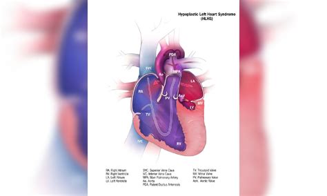 Study finds new genes that may contribute to congenital heart diseases