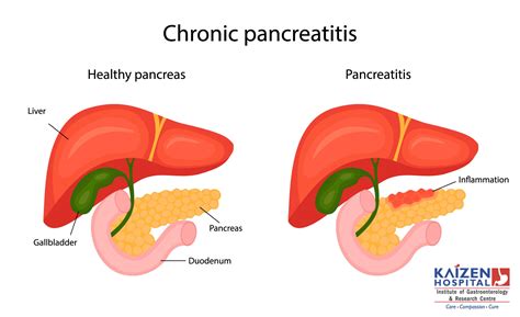 Pancreatitis: Symptoms, Causes & Treatment in Ahmedabad, Gujarat, India