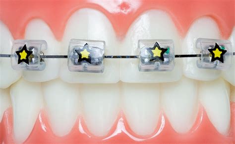 Braces Bumper Cover Orthodontic Bracket Wax Substitute Alternative Snap ...