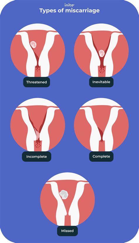 Miscarriage Vs Menstruation