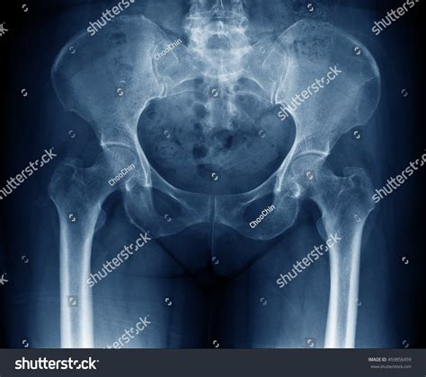 Normal Pelvis X Ray