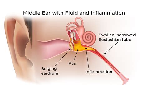 Middle Ear Infections | My Doctor Online