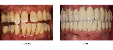 Best Dental Implants HSR Layout | Dental Implants Near Me Rajajinagar ...