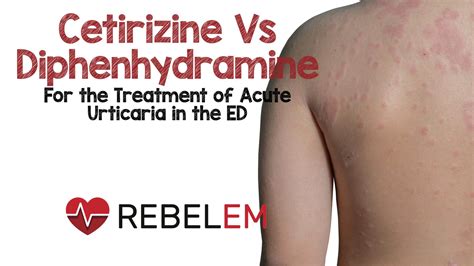 Cetirizine Vs Diphenhydramine For the Treatment of Acute Urticaria in the ED - REBEL EM ...
