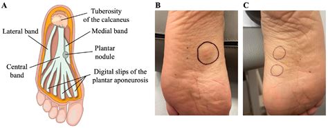Pain-Relieving Effects of Shockwave Therapy for Ledderhose Disease: An ...
