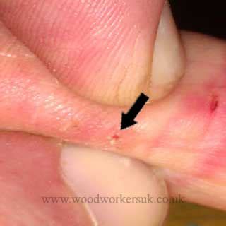 Image result for Infected Splinter Removal