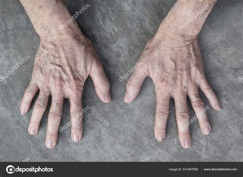 Age Spots Hands Asian Elder Man Brown Gray Black Spots — Stock Photo © zaynyinyi #531947890