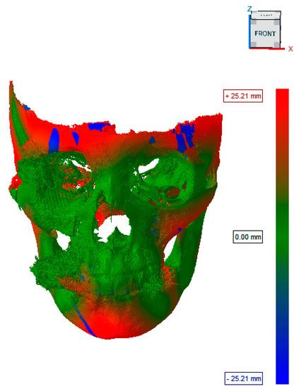 A Case Report of Zygomatic Fracture Reconstruction: Evaluation with ...