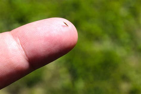 Image result for Hair Splinter Infection