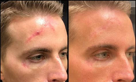 Scar Revision Procedure 的图像结果