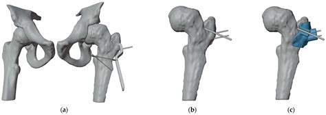 In Situ Fixation and Intertrochanteric Osteotomy for Severe Slipped ...