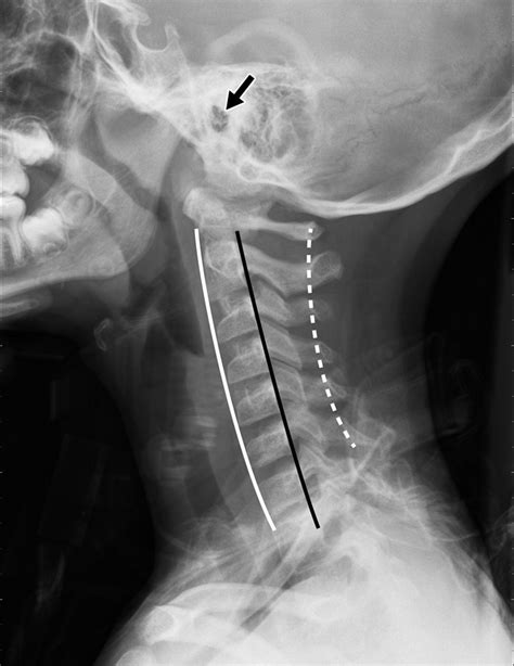 Normal Cervical Spine Radiographs Image Radiopaediaorg Cervical Spine