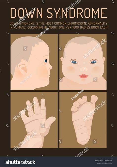 Symptoms Down Syndrome Poster Abnormal Ears Stock Vector (Royalty Free ...