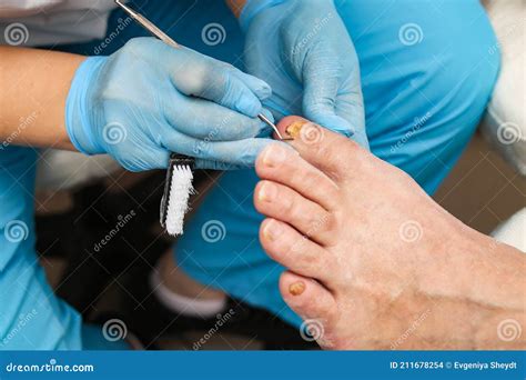 Doctor For Ingrown Nails