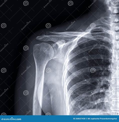 X Ray Shoulder Joint Anatomy at Darcy Poninski blog