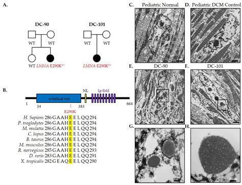 Diagnostic Yield of Whole Exome Sequencing in Pediatric Dilated ...