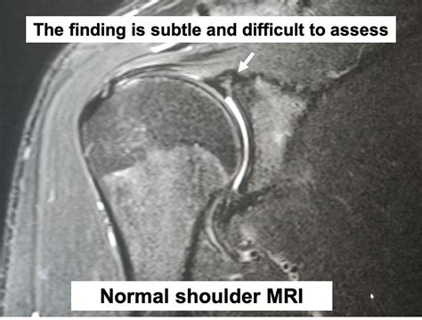 Mr Arthrogram Shoulder 的图像结果