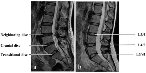 Lumbosacral Transitional Vertebra Contributed to Lumbar Spine ...