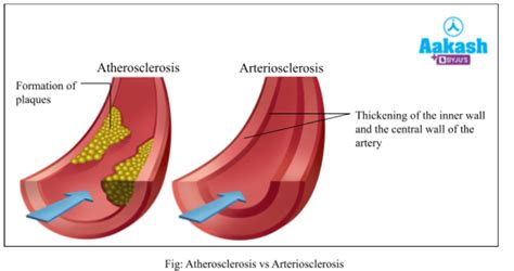 Circulatory System Disorders: Hypertension, Coronary artery disease ...