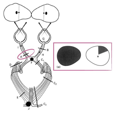 Image result for Nasal Step Visual Field Defect
