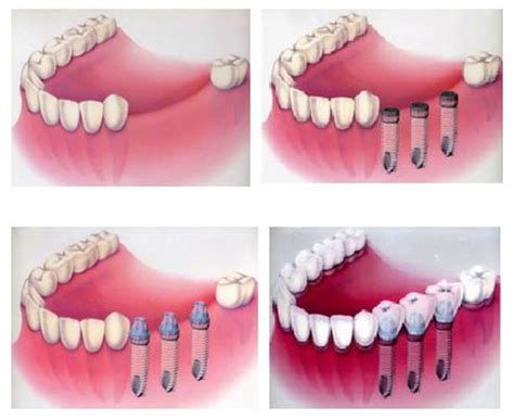 全口种植牙要种多少颗？上颌和下颌各种植4-8颗牙就足够了 - 口腔资讯 - 牙齿矫正网